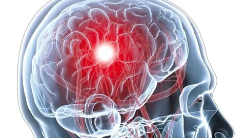 شایع‌ترین علایم سکته مغزی