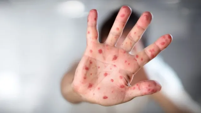چرا باید واکسین سرخکان بزنیم؟